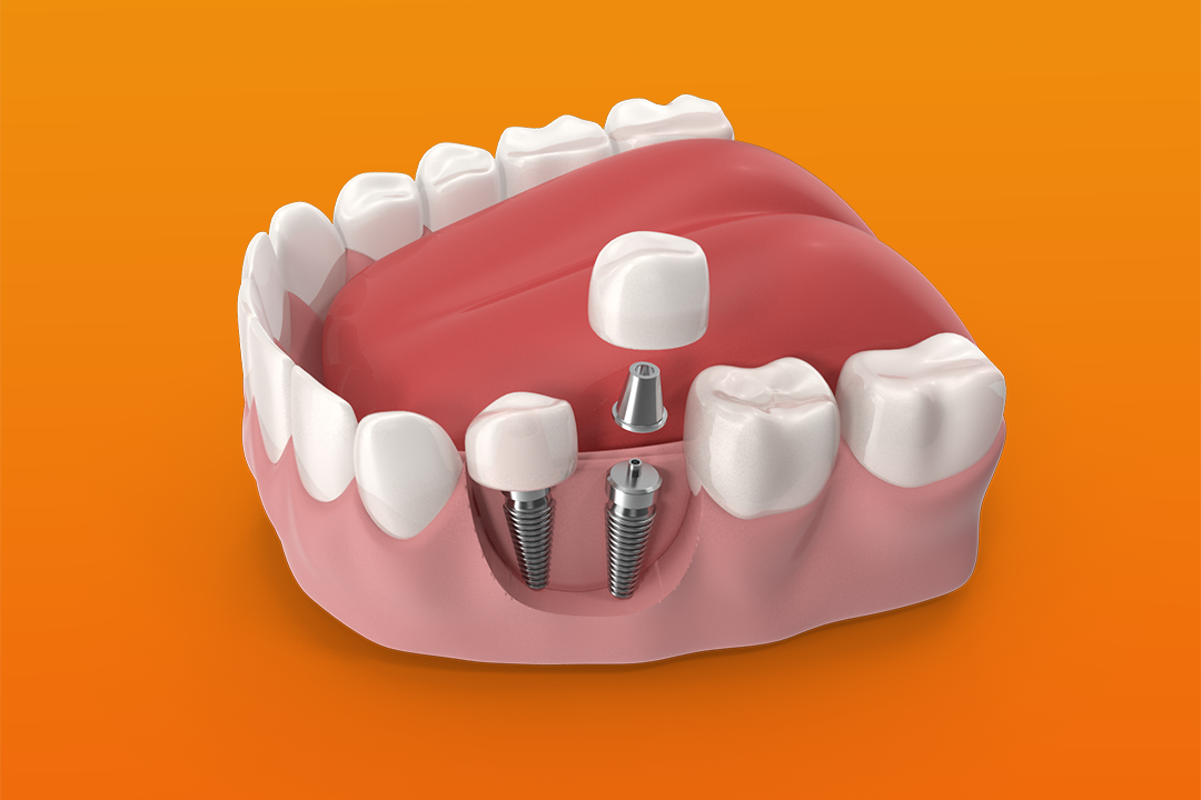 Mouth Implant copy